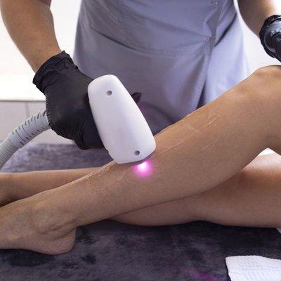 Laser hair removal