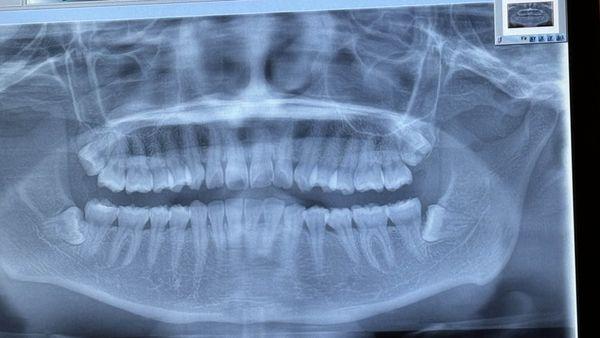 Horizontal wisdom teeth that needed to be extracted ASAP