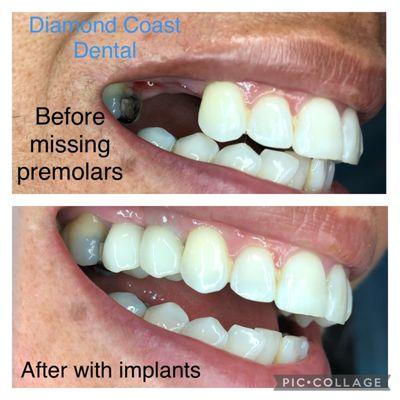 Costmetic implant dentistry at Diamond Coast Dental