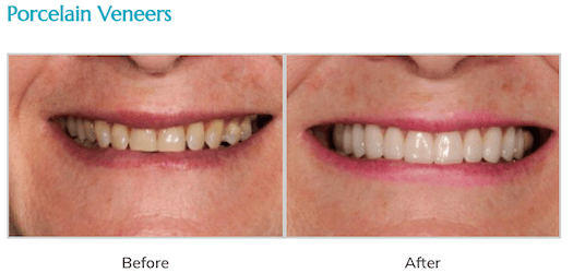 Before and After Porcelain Veneers