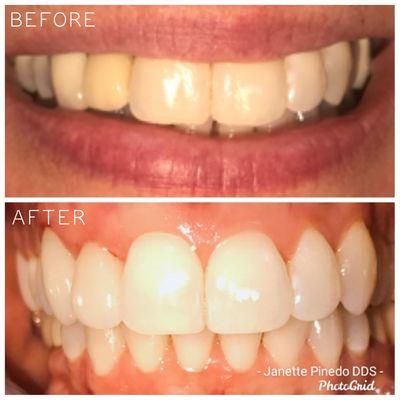 PT came in with 2 Crowns (Upper Left) that didn't quite match the rest of her smile. An easy fix for Dr. Pinedo. :)