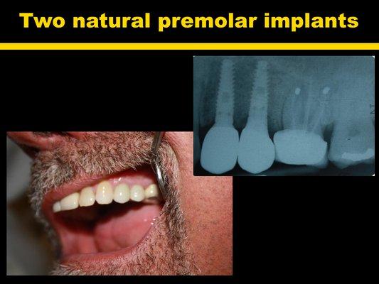 Two natural premolar implants