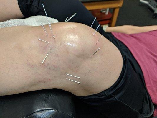 Needling.