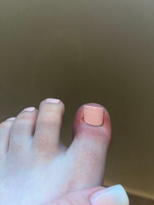 Infection from pedicure