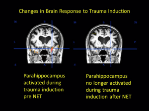 Brain changes before and after treatment with Neuro Emotional Technique, NET. Life Changing...Brain Changing!