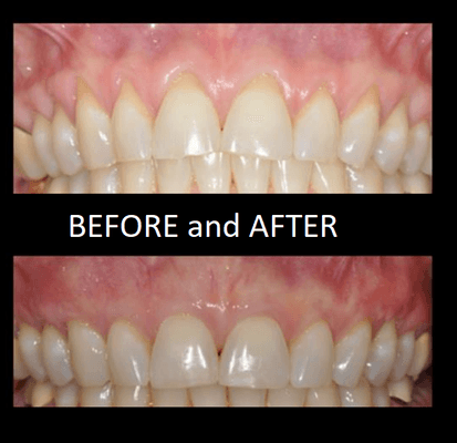 Soft Tissue Grafting was done to treat the gum recession.