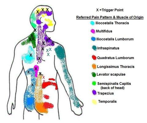 Trigger Point therapy. Pain patterns.