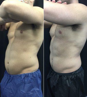 Fat reduction and muscle building with truSculpt iD