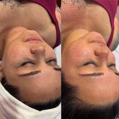 Before and afters from Hydrafacial! The ultimate facial to get