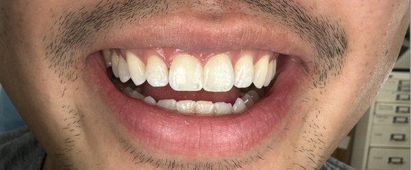 After diastema/front teeth gap closure