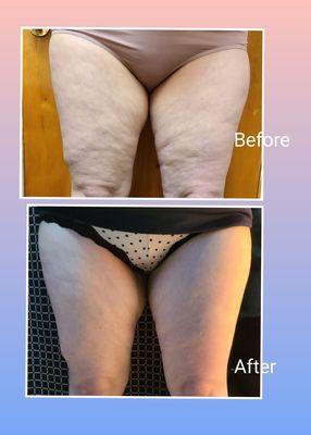 Before and After Cellulite Treatment