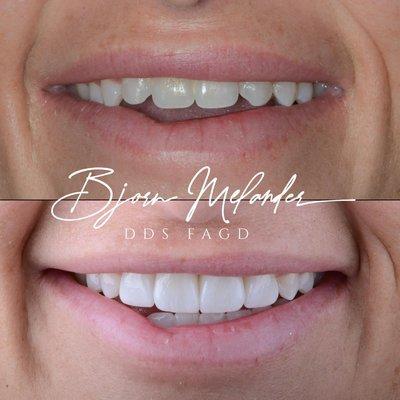 Four same day ultra thin veneers- no temporaries needed!