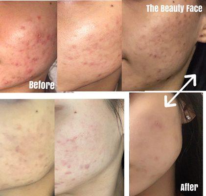 Acne Treatment (Progression of Work done)