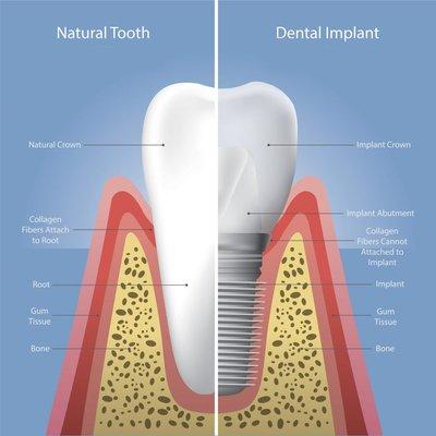 Dental Implant