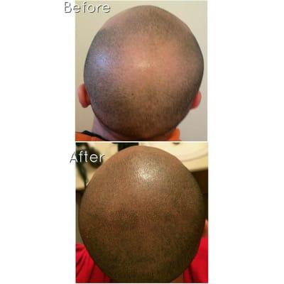 Scalp micropigmentation, Hair replacement tattoo