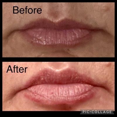 Lips with no work ever done...lips a week after Botox lip flip.