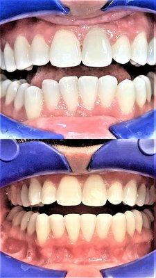 Top is before, bottom is after. Unfortunately, the after pic doesn't accurately show the positive effects of the teeth whitening