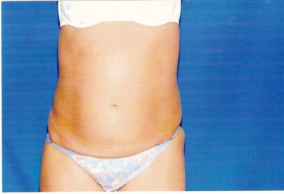 Liposuction Before