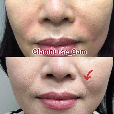 Nasolabial fold Filler by Cam, RN