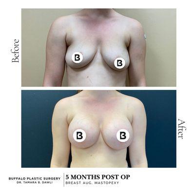 breast aug and lift