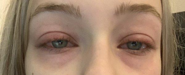 Before urgent care after lashes removed