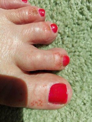 The red dots on my big toe were not there when I went in - 4th toe is the worst - can't wear a regular shoe now.