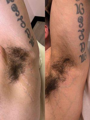 Stretch mark cover up