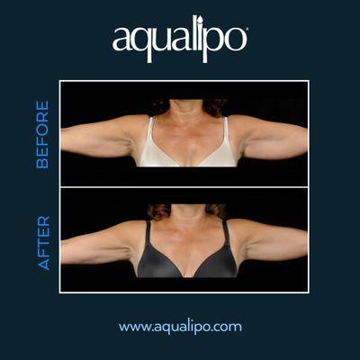 Arm liposuction in Orlando is effective in removing excess fat that often hangs below the bicep.