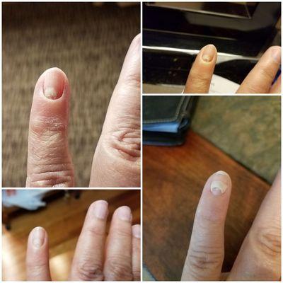 Nail infection.