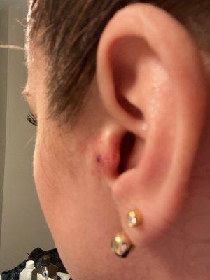 Tragus pierce hole and swelling