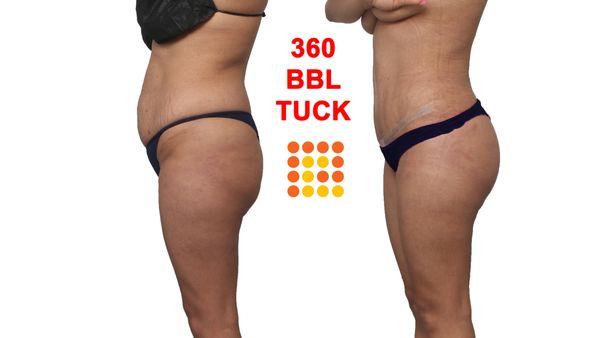 Tummy Tuck. With lipo 360 and BBL for a tighter, youthful appearance.