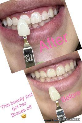 1 hr teeth whitening