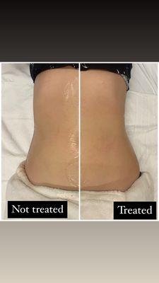 Sol Bod (skin tightening, body contouring)