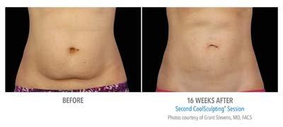 CoolSculpting before and after