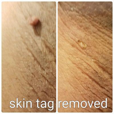 Skin Tage remove