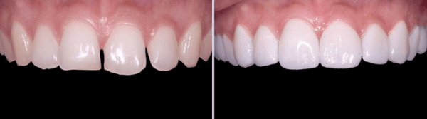 Dental Veneers, Whitening, and Filling Completed on Patient :)