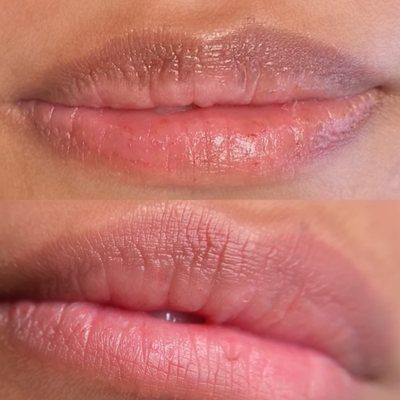 Before and after Lip Neutralization by @Paramedinks