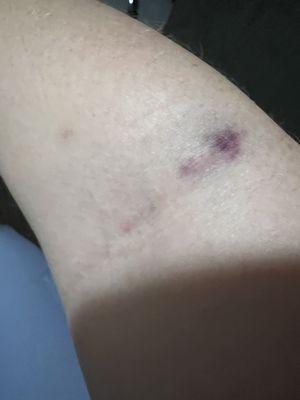 Bruising post one day after blood work