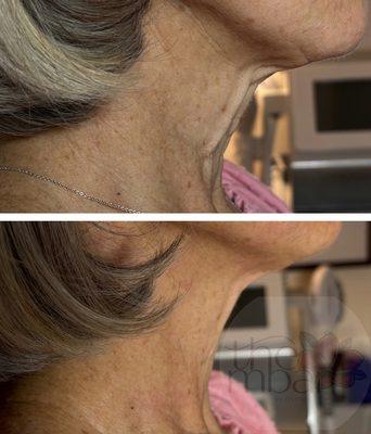 Hifu : non surgical neck lift results