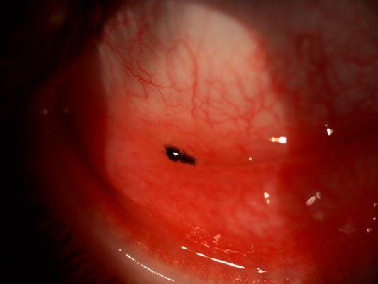 Bug found in teenager's eyelid