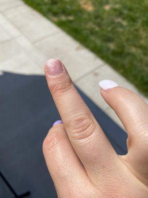 We had to cut my nail all the way to the skin