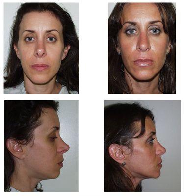 Revision Rhinoplasty ^  This 37 year old female underwent a primary rhinoplasty 20 years before the current treatment.