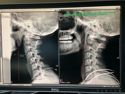 Amazing progress for my Soccer-playing daughter's neck issue- thanks to Dr. Stanley Henderson!