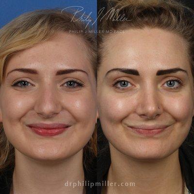 Rhinoplasty, before and after.