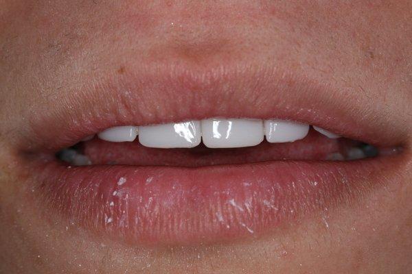 Actual Patient - 3 of 3 - After Cosmetic Teeth Bonding by Dr. O'Braitis. Notice the youthful appearance of the teeth when relaxed.