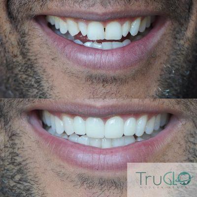 This is a very conservative natural veneer placement on the forefront teeth, to fix the appearance of the peg laterals.