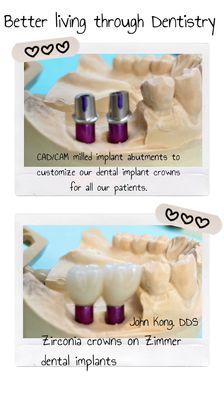 Dental implant crowns fabricated over custom CAD/CAM milled titanium abutments