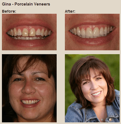 Porcelain Veneers in Denver