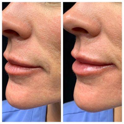 Lip Rejuvenation