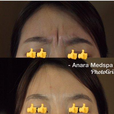 Deep furrow on forehead eliminated with Botox/Dysport